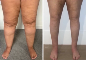 Leags Ankles Feet shrink 5